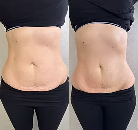 Carol B., 58 before and after herDOSE
